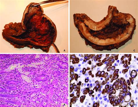 Types Of Gastric Carcinoma By Lauren Classification A And B