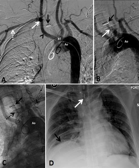 Aortic Angiography A Digital Subtraction Angiography Image After