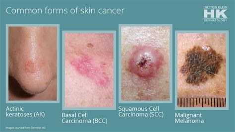 Skin Cancer Look Like