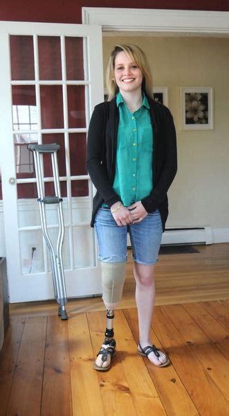 Amputee Legs Stumps And Prostheses