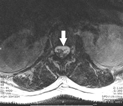 Lumbar Mri Axial T2 Sequence Without Contrast Enhancement Showing