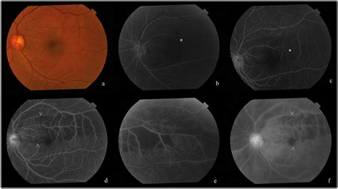 Recurrent Retinal And Choroidal Ischemia In A Case Of Ocular Ischemic
