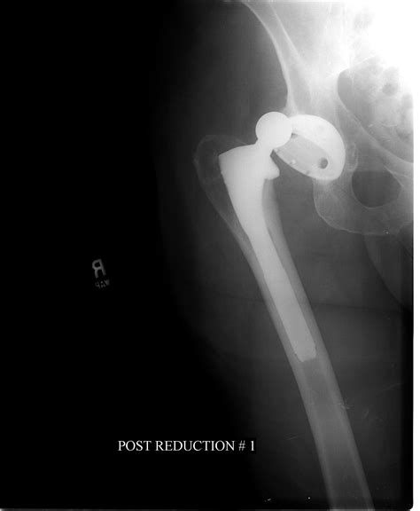 Prevent Hip Replacement Dislocation