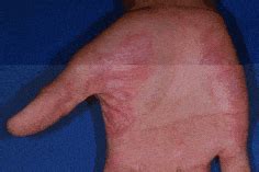 A psoríase nas mãos é um profundo inconveniente, não só pelos sintomas, mas também devido ao preconceito. Psoríase