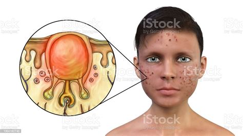 Acne Vulgaris In A Teenager Boy And White Comedone Stock Photo