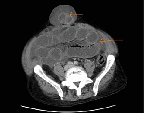 Incarcerated Umbilical Hernia Following Therapeutic Paracentesis In A
