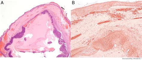 A Tumor In Images Anetodermic Pilomatrixoma Actas Dermo Sifiliográficas