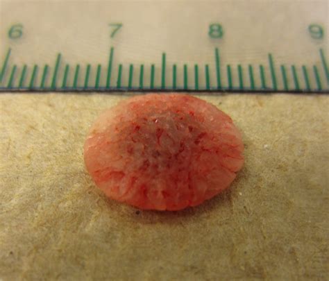 Bladder Stones Why They Form And How To Prevent Them Parkdale