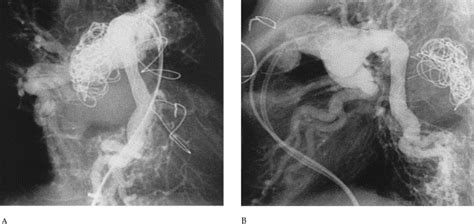 Endovascular Stent Graft Treatment Of A Pulmonary Artery Pseudoaneurysm
