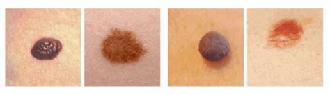 Skin Cancer Moles Early Stages 10 Signs Of Skin Cancer
