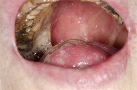 Oral Thrush In Mouth Cancer Stock Image C0155946 Science Photo Library