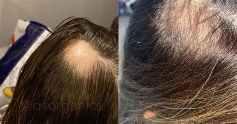 Ce sont les causes de la perte de cheveux chez les femmes au début de