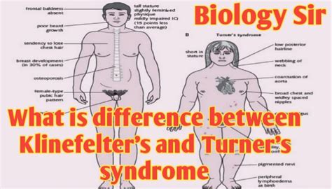 Differences Between Klinefelters And Turner Syndrome Biologysir