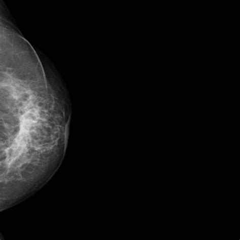 Left Breast Ultrasound Download Scientific Diagram
