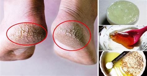 Feet Are Commonly Being Affected By Dry And Rough Skin And This