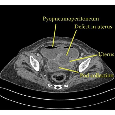 A Axial Contrast Enhanced Ct In Venous Phase Reveals Pyometra