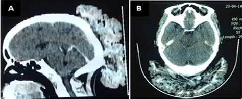 Giant Cerebriform Nevus Cell Nevus Of The Scalp A Case Report