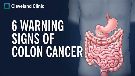 6 Warning Signs Of Colon Cancer Updated For 2023 All About Diabetes