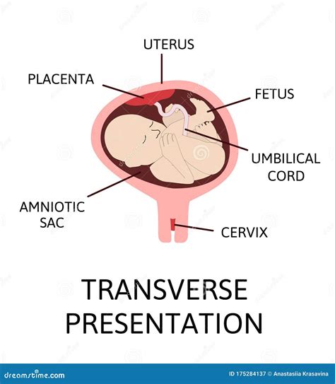 Different Baby Positions In The Uterus During Pregnancy Stock