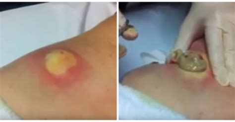 Omg This Huge Cyst Popping Is Just Too Much