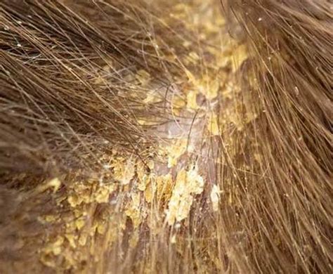 Do I Have Dandruff Or Scalp Psoriasis Flaking Scalp Causes Treatment