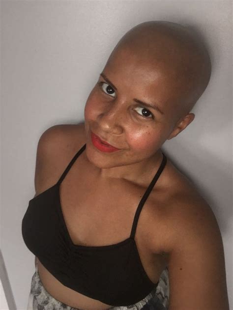 Bald Nohairdontcare Baldness Cancersurvivor Cancer Hair Loss