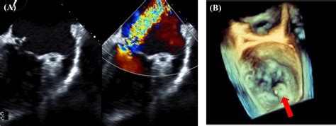 Cardiac Calcified Amorphous Tumor With Mitral Valve Perforation A Case