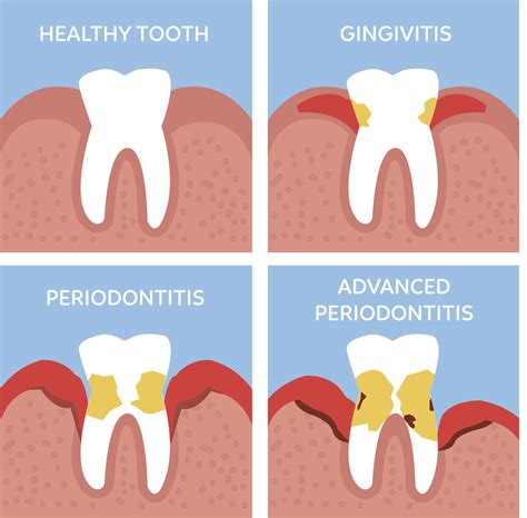 Learn The Core Causes Of Gingivitis And How Your Dentist Can Help You