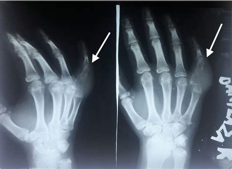 Bone Tumor X Ray