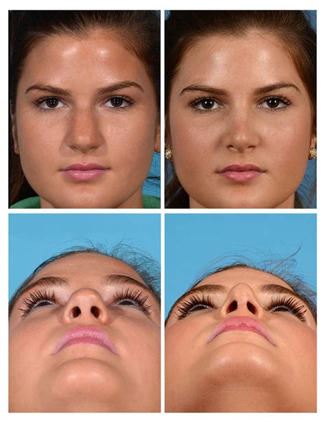 Nose Job Surgery Before And After