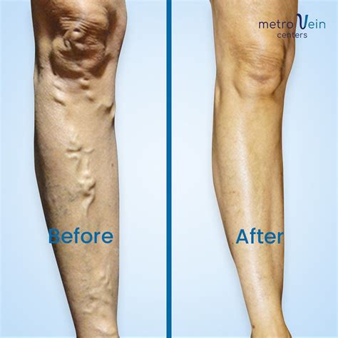 Varicose Veins Treatment Riverview For Quick Vein Removal Artofit