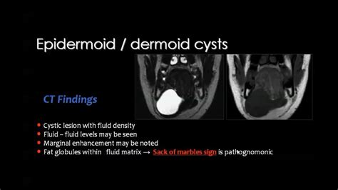 Dermoid Cyst Dermoid Cyst Nuclear Medicine Cysts