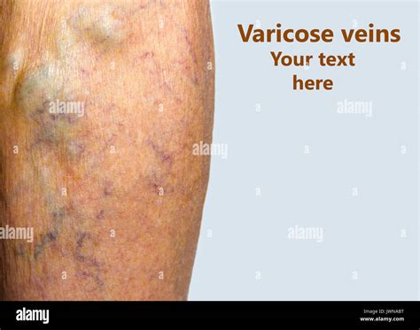 Varicose Veins On A Leg Stock Photo Alamy