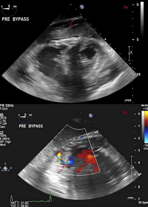 Diagnosis Of Free Wall Rupture By Left Ventricular Angiogram After