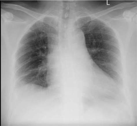 Chest X Ray Showed Cardiomegaly With Atherosclerosis Aorta With No