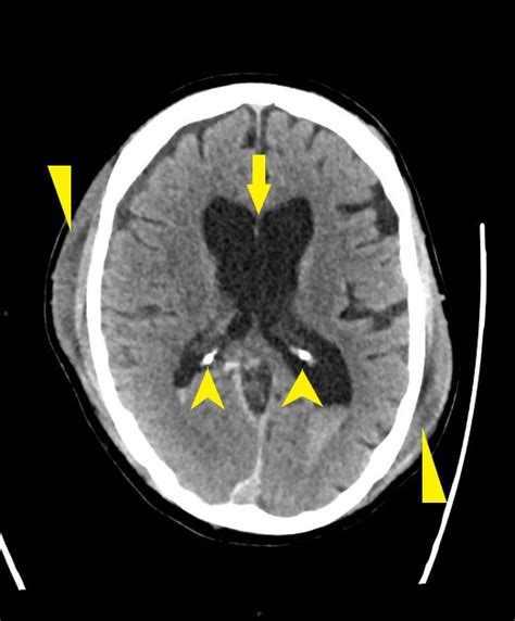 Traumatic Brain Injury Ct Wikidoc