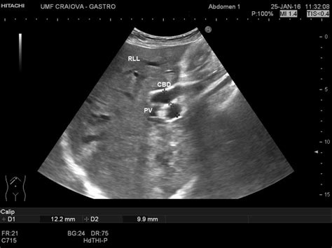 Dilatation Of The Common Bile Duct 2 Images Efsumb