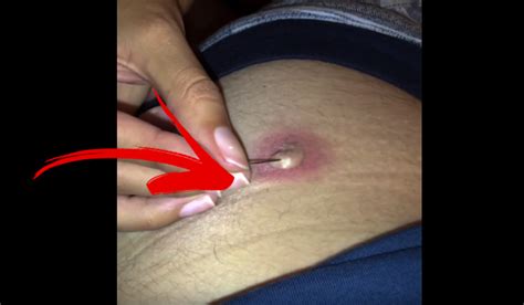 This is called a foreign body reaction and is similar to what happens when a wooden splinter gets. Cyst from ingrown hair
