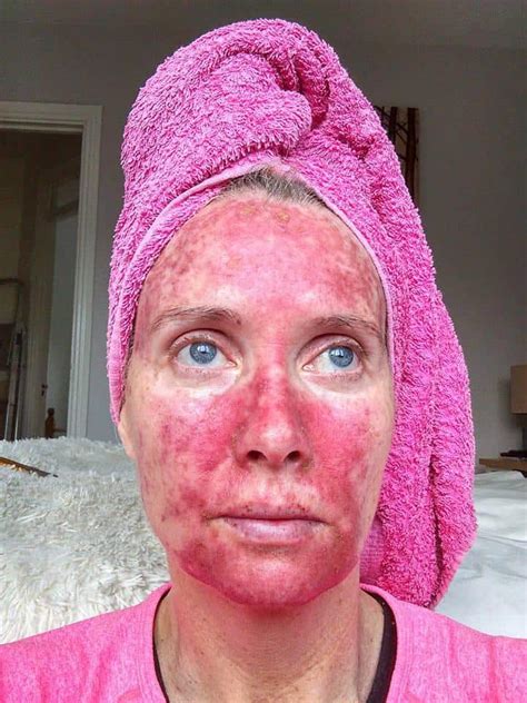 This “tan Addict” Mom Is Sharing Graphic Photos To Show The Harmful