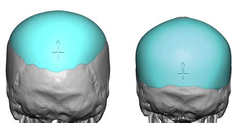 Blog Archivecase Study Custom Skull Implant Replacement