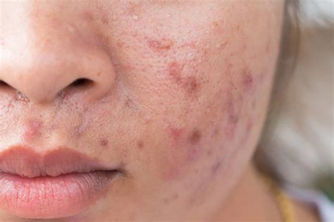 Acne Breakout What Your Acne Says About You Readers Digest