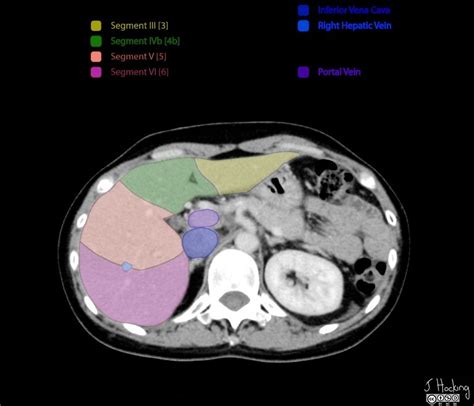 Liver Segments Annotated Ct Radiology Case Liver