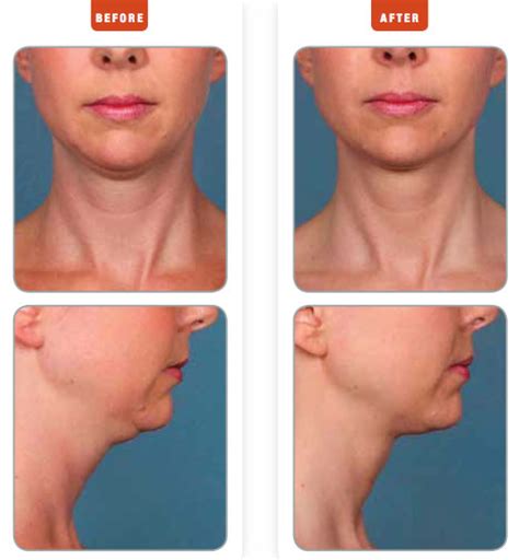 Kybella™ A New Nonsurgical Treatment For Submental Fullness