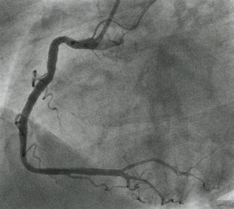 Coronary Angiographic Views All About Cardiovascular System And Disorders