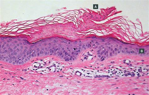 Racgp Precancerous Skin Lesion Often Misdiagnosed
