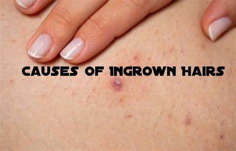 What Are The Natural Remedies To Prevent Ingrown Hair
