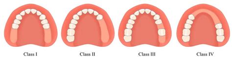 Kennedy Classifications Of Removable Partial Dentures Download