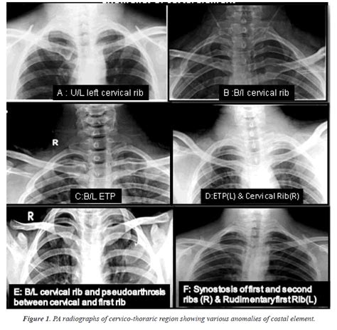 Prevalence Of Various Anomalies Of Costal Element At Cervico Thoracic