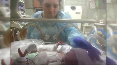 Baby Born Without Skin Hopes To Get Life Saving Treatment