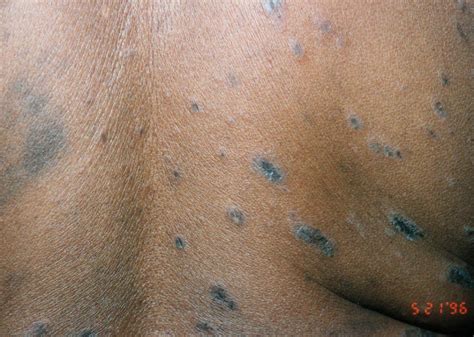 Pityriasis Rosea Pictures Causes Symptoms And Treatment